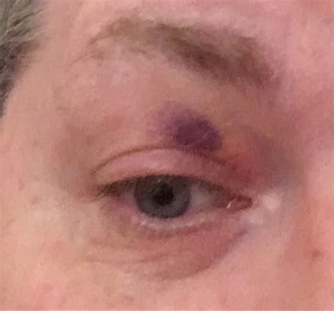 Semaphor Versteigerung Homosexuell Woke Up With Bruise In Corner Of Eye