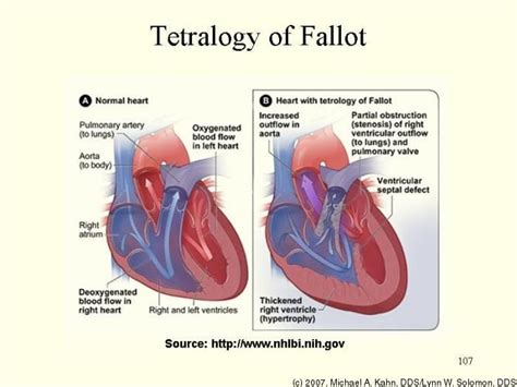 Tetralogy Of Fallot Tetralogy Of Fallot Atrial Septal Defect