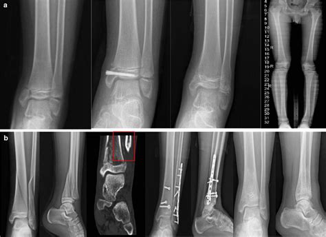 A An 11 Year Old Patient Salterharris Type Ii Distal Tibia Physeal