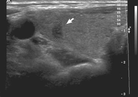 The Ultrasonography Of Thyroid Showed 06 Cm Hypoechoic Nodule In The