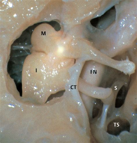 1 Anatomy and Radiology of the Normal Temporal Bone | Ento Key