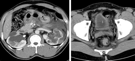 Eosinophilic Cystitis Detected With Blunt Renal Trauma Radiology Cases