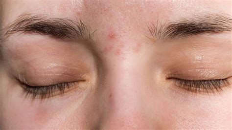 Whats Causing Acne Between Your Eyebrows And How Do You Get Rid Of It