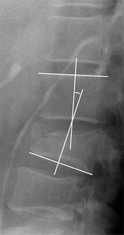 Measurement Technique For Segmental Kyphosis Angle Measured By Cobbs