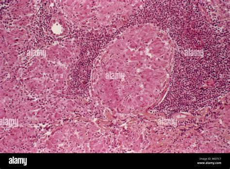 La Tuberculosislight Micrografía De Una Sectionthrough Un Ganglio