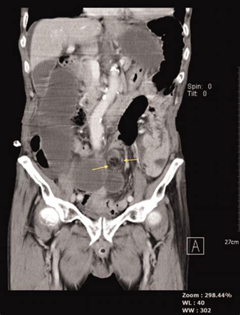 Diagnosis Of Sigmoid Volvulus Using The Coffee Bean Northern Exposure Sign Whirl Sign And