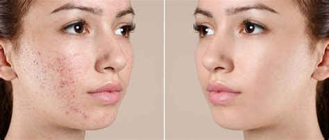 Learn All About Blemish Prone Skin And Its Treatments