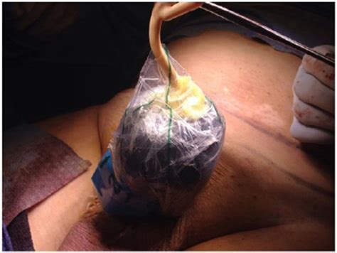 Fournier gangrene (fg) is a type of wet gangrene. Fourniers / Model Ari Fournier's Agent Says She Is ...