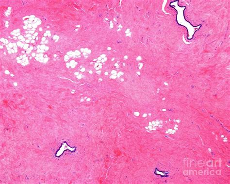 Breast Fibrosis Photograph By Jose Calvo Science Photo Library Fine