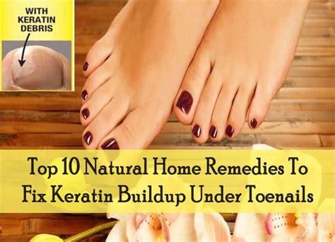 Top 10 Natural Home Remedies To Fix Keratin Buildup Under Toenails