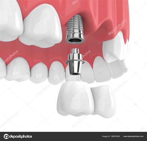 Render Implants Dental Cantilever Bridge Upper Jaw