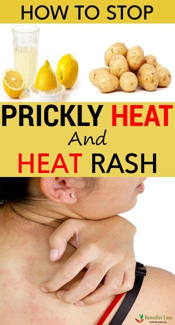 How To Get Rid Of Heat Rash Quickly Rash Remedies Heat Rash Rashes
