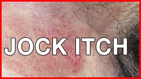 How To Cure Jock Itch Causes Of Jock Itch And Remedies Youtube