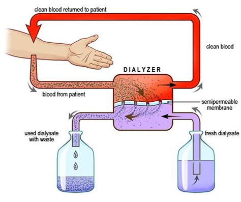 Start studying biology 1107 dialysis lab. Diagram showing the hemodialysis process. Blood from the patient enters the dialyzer, where it ...