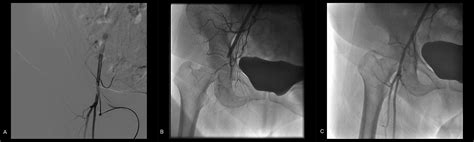 Cureus Treatment Of Angio Seal Vascular Closure Device Induced Acute