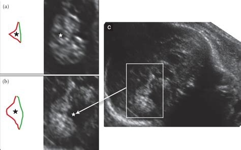 Prenatal Abnormal Features Of The Fourth Ventricle In Joubert Syndrome