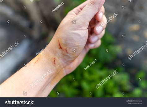 Hand Bloody Scars Cat Scratch Prevent Stock Photo 1544357276 Shutterstock