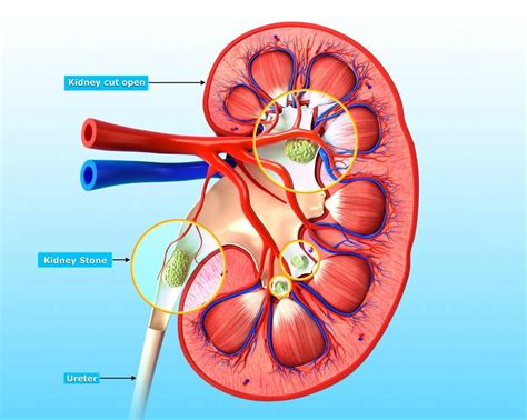 Read the next section for home remedies that will prevent. Home Remedies for Kidney Stones | ThriftyFun