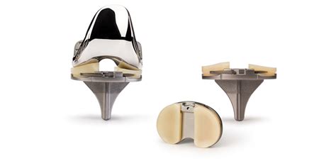 First-Ever Talus Replacement Using 3D Printing ...