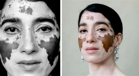 Une Photographe Avec Le Vitiligo Réalise Des Clichés Où Elle Illustre