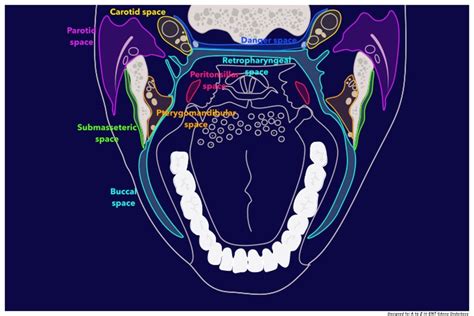 Deep Neck Space Infections — A To Z In Head And Neck Surgery