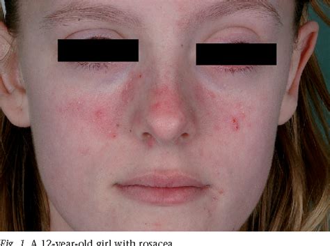 Figure 1 From Childhood Rosacea A Review And Case Report Semantic