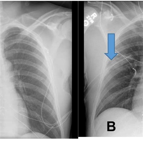 Thoracic computed tomography after repair of a bleeding left axillary ...