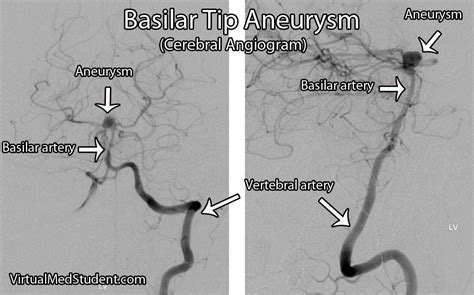 Basilar Artery Aneurysms