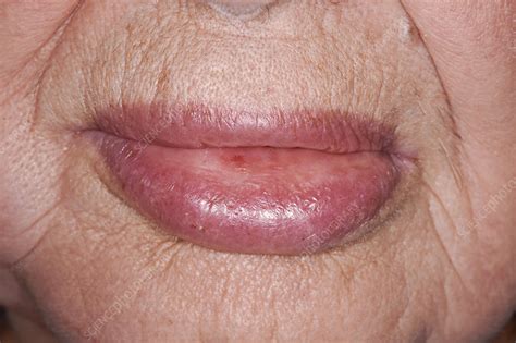 Angioedema Of The Lower Lip Due To Drug Reaction Stock Image C040