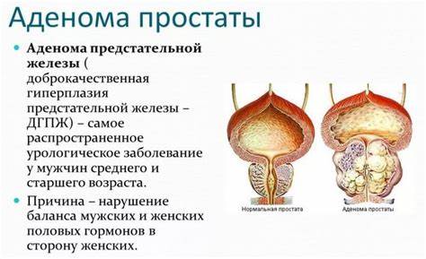 Аденома предстательной железы (Аденома простаты) - причины, виды Картинка - Аденома предстательной железы (Аденома простаты) - причины, виды