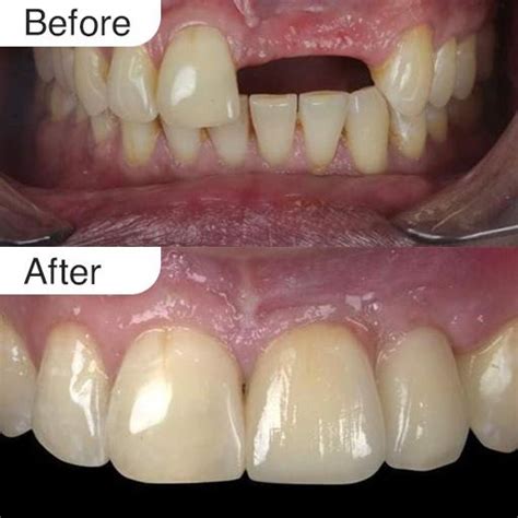 Cdic Before And After Cosmetic Dental Implant Centre Cdic Wakad