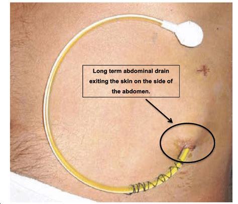 Rocket Medical Long Term Abdominal Drain In Situ 25 Download