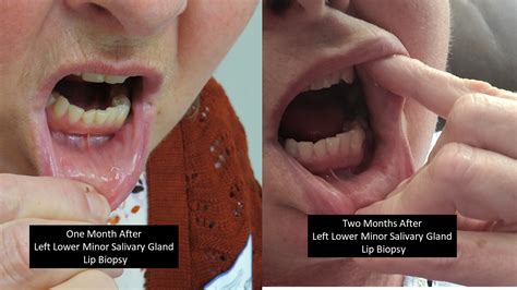 Sequence Of Healing After Lip Biopsy For Sjogren S Syndrome Minor Salivary Gland Biopsy Iowa