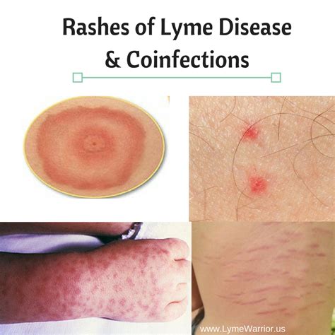 Rashes Of Lyme Disease And Coinfections — Lyme Warrior Lyme Disease