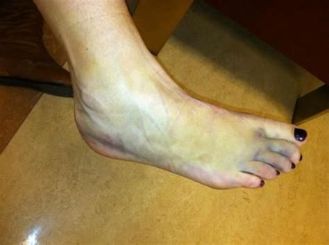 A sprain is a stretch or tear in a ligament.ligaments are bands of fibrous tissue that connect bones to bones at joints. Immediate Care of Acute Ankle Sprain | Sprained ankle remedies, Sprained ankle, Sprain
