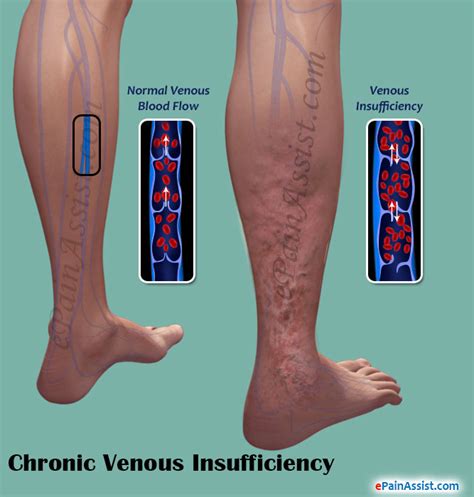 What Is Chronic Venous Insufficiency And How Is It Treated