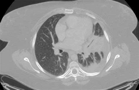The Chest Ct Revealed Left Pleural Effusion Left Pneumonia With
