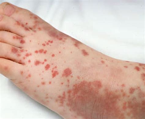 Purpura Pictures Causes Symptoms And Treatment 2018 Updated