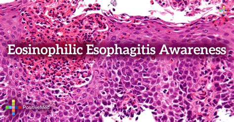 Eosinophilic Esophagitis Awareness Positivemed