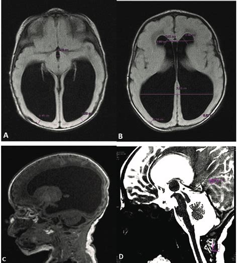 Mri Examination Of The Brain Of The Neonate With Congenital