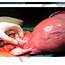 Fibroid Cyst In Uterus  ULTRASONIDO DOPPLER PORTATIL E CUBE I7