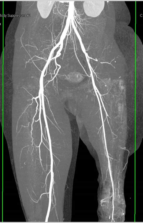 Lower Leg Vascular Anatomy