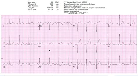 Patient 1 Borderline Stemi Clear Omi From Diagonal Occlusion