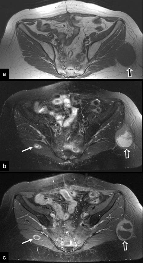 Bilateral Gluteal Metastases From A Misdiagnosed Intrapelvic