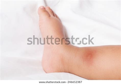 New Born Multiple Mosquito Bites On Stock Photo Edit Now 246652387