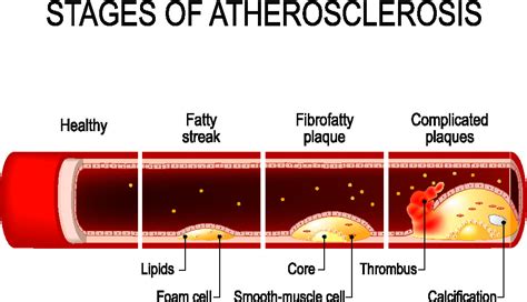 Atherosclerosis The Johns Hopkins Patient Guide To Diabetes