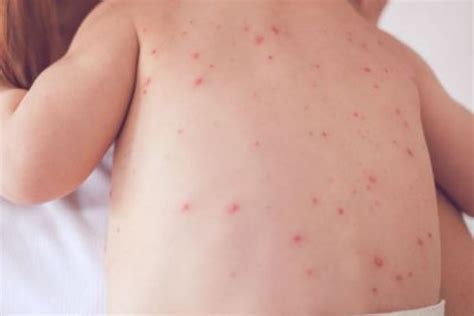 Measles And Its Cure Ring A Doctor Blog