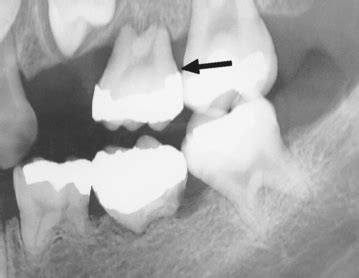 Like any dental procedure, you can expect some minor side effects or uncomfortable feelings to get used to the first few days after. 7: Acquired and Developmental Disturbances of the Teeth ...