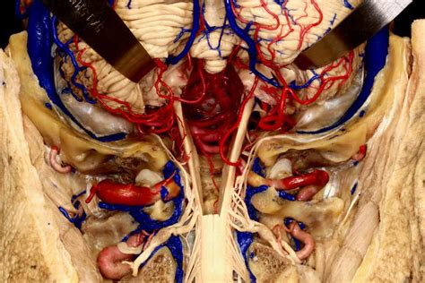 Suboccipital Craniectomy with Cerebellum Retracted | Neuroanatomy | The