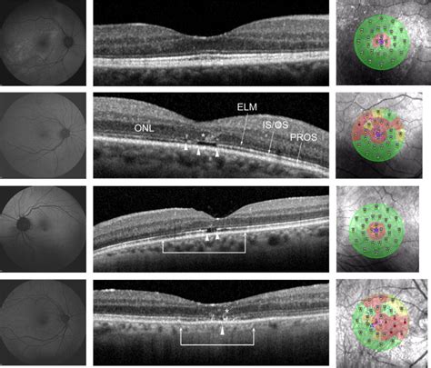 Anatomical And Functional Macular Changes After Rhegmatogenous Retinal